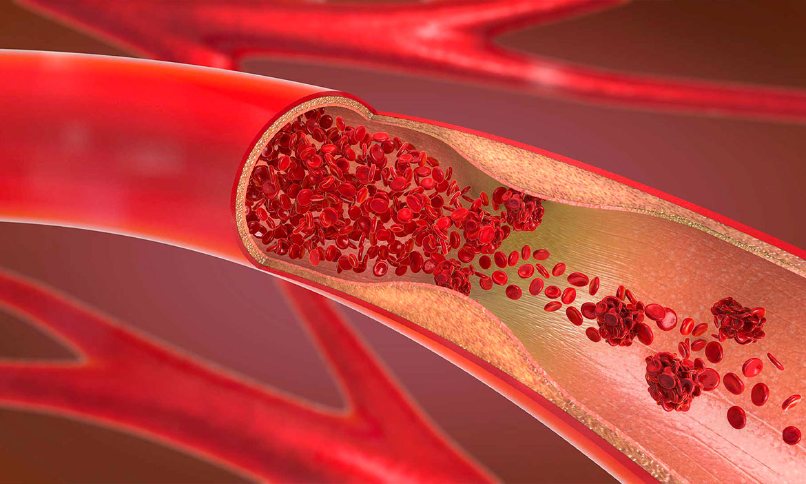 ¿Qué es la angiología, cirugía vascular y endovascular? 